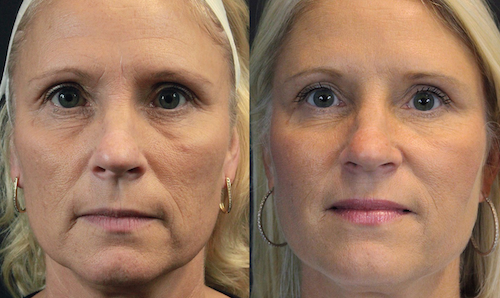Thread Lift non surgical facelift before after mississauga oakville toronto